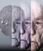 Dal PD di Ficulle allarme: “Perché ancora non è realizzato il Centro Alzheimer?