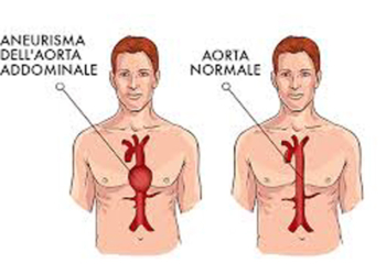 Aneurisma all’aorta addominale, l’ospedale di Acquapendente partecipa all’Open Day